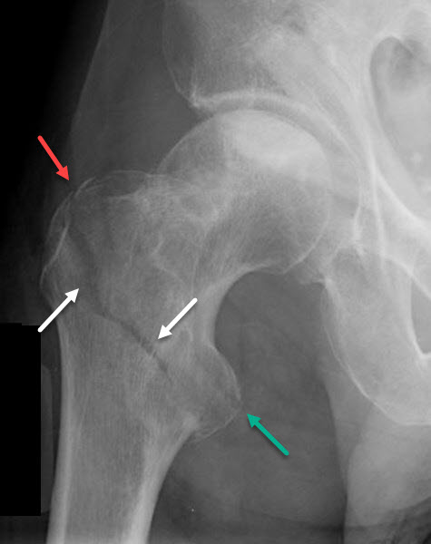 intertrochanteric fracture